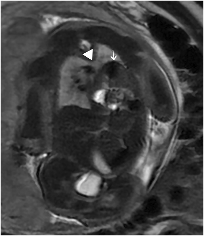 Prenatal Diagnosis of Horseshoe Lung: A Report of Three Cases and Review of the Literature.