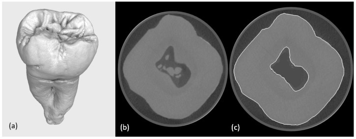 The Integration of Micro-CT Imaging and Finite Element Simulations for Modelling Tooth-Inlay Systems for Mechanical Stress Analysis: A Preliminary Study.