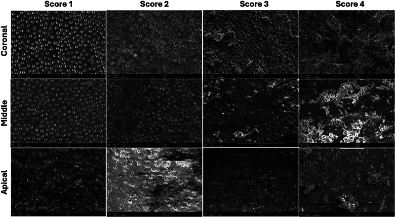 Effect of Apical Preparation Size and Preparation Taper on Smear Layer Removal Using Two Different Irrigation Needles: A Scanning Electron Microscopy Study.