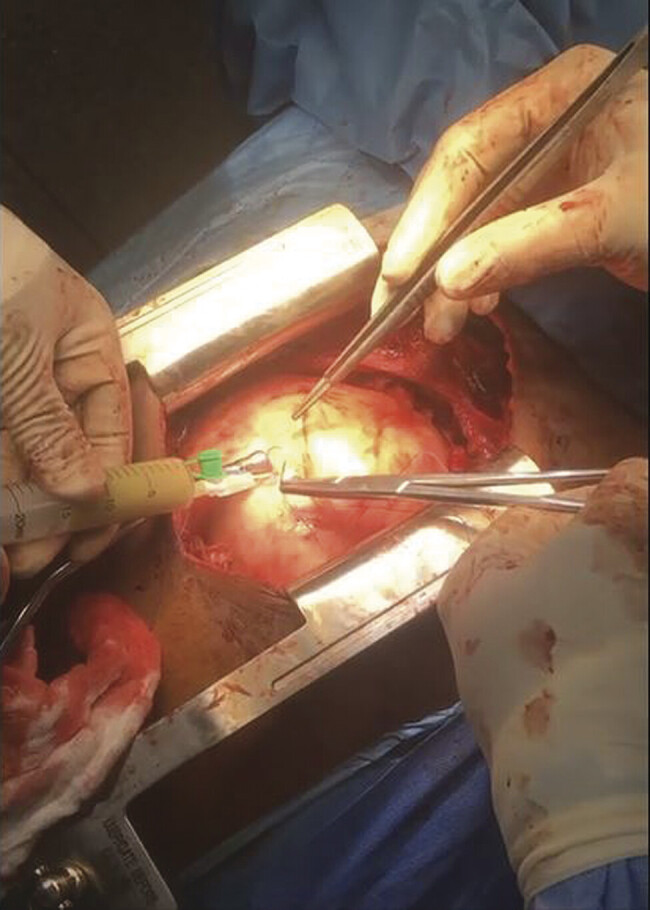 Cardiac Tamponade Secondary to a Giant Pleuropericardial Cyst in a Child: A Surgical Case Report from Sub-Saharan Africa.