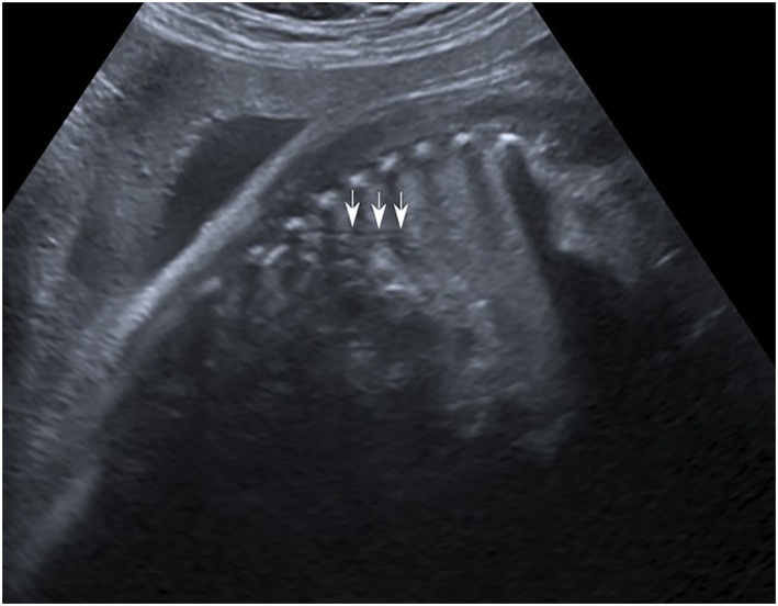 Prenatal Diagnosis of Horseshoe Lung: A Report of Three Cases and Review of the Literature.