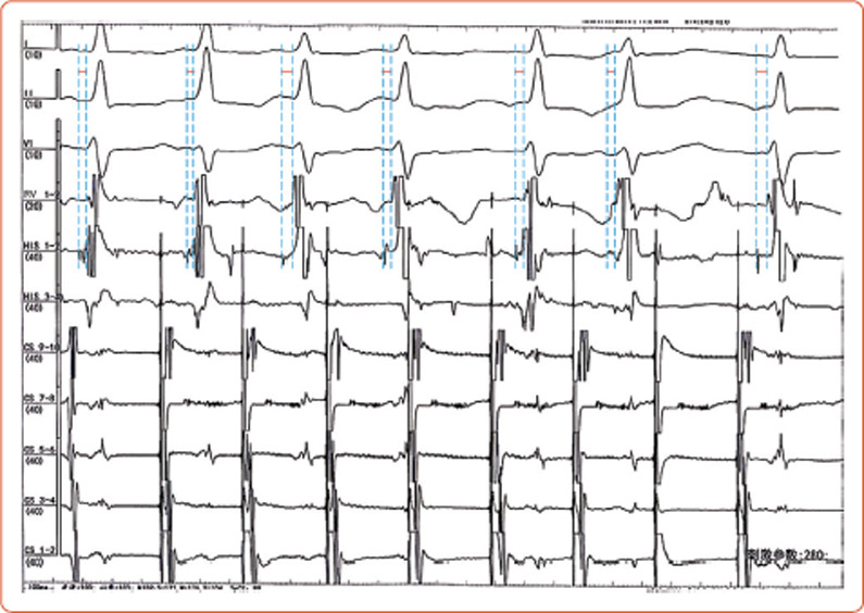 A Fasciculoventricular Accessory Pathway Featuring Functional Decremental Conduction and QRS Variability.