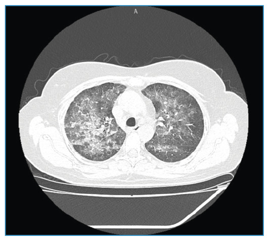 Methotrexate-Induced Pneumonitis in a Patient with Chronic Chikungunya Arthritis.