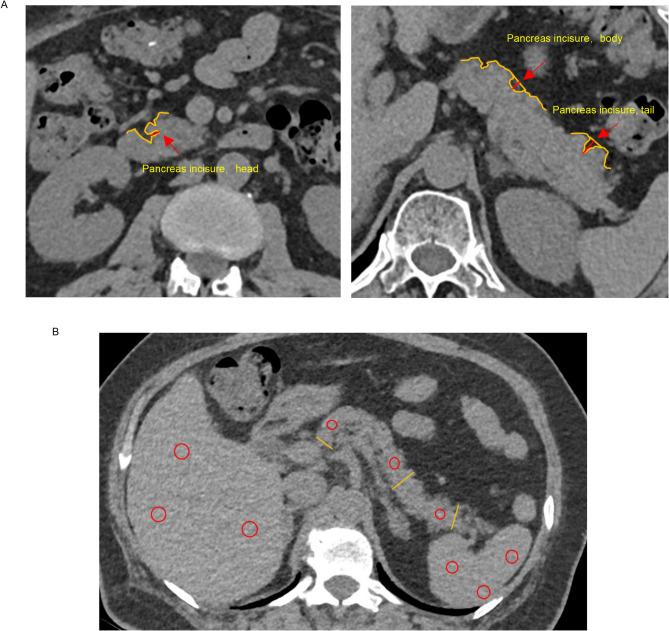 Increased depth of pancreas incisure on computed tomography as an independent predictor for T2DM.