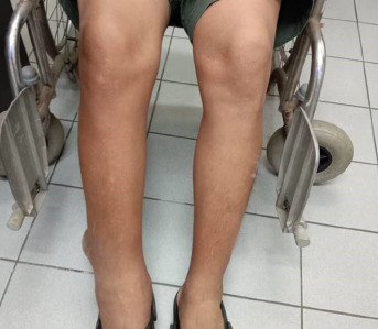 Lymphoedema - Filariasis or soft tissue sarcoma? A case report.