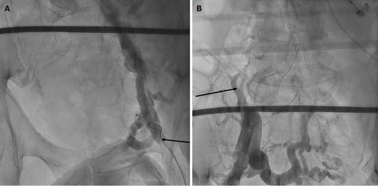 Novel approach to pulmonary vein isolation ablation <i>via</i> right internal jugular access: A case report.