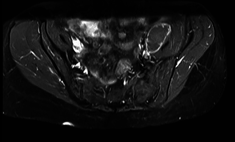 Active tuberculosis and multiple sclerosis: the importance of screening before treatment.