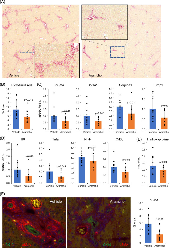 Aramchol attenuates fibrosis in mouse models of biliary fibrosis and blocks the TGFβ-induced fibroinflammatory mediators in cholangiocytes.