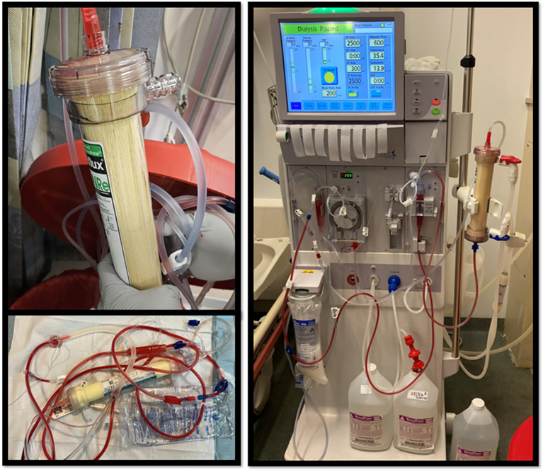 Case Report: Fruquintinib-induced hyperbilirubinemia: a rare cause of dialyzer filter discoloration in a patient undergoing long-term dialysis.