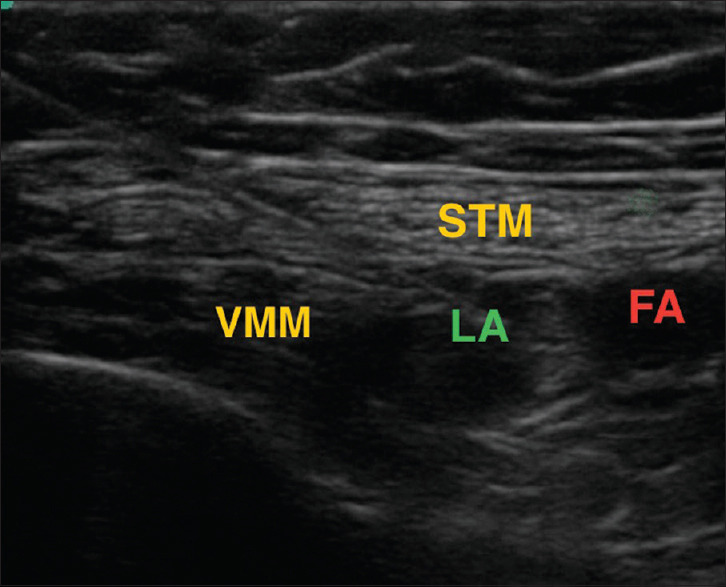 Comparative analysis of dual versus single subsartorial block for postoperative analgesia after total knee arthroplasty - A randomized, double-blind study.