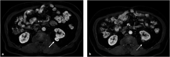 Microwave ablation versus combined microwave ablation and transarterial chemoembolization for T1a renal cell carcinoma: a Single-Center retrospective study.
