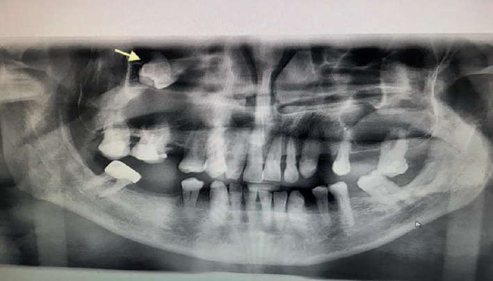 A Rare Case Report of a Large Dentigerous Cyst in the Maxillary Sinus Associated With an Ectopic Maxillary Third Molar.