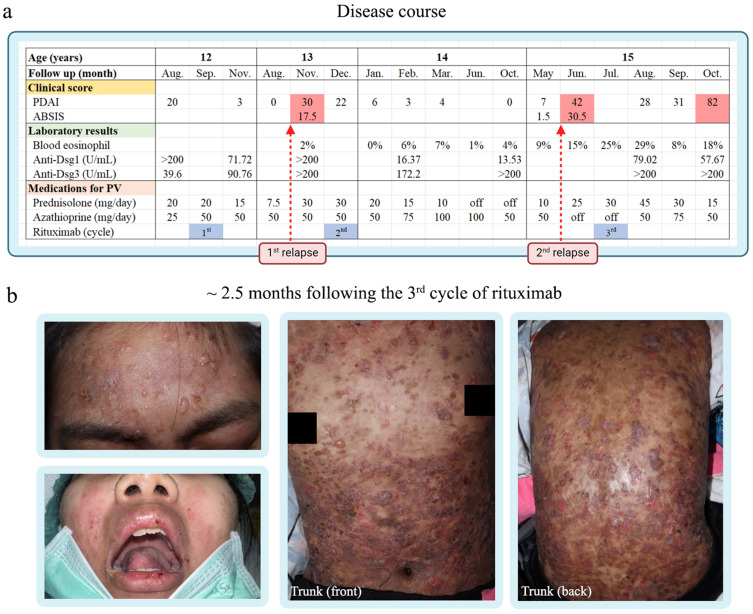 Dupilumab as Immunomodulatory Rescue for Severe Recalcitrant Pemphigus Vulgaris: A Case Report and Literature Review.