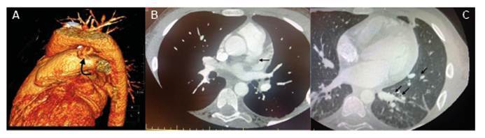 Unveiling Silent Patent Ductus Arteriosus with COVID-19.