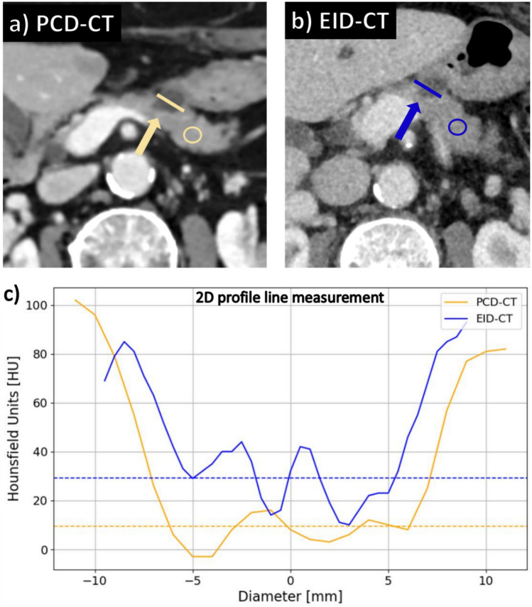 Simple cystic lesions of the pancreas: image quality and diagnostic accuracy of photon-counting detector computed tomography.