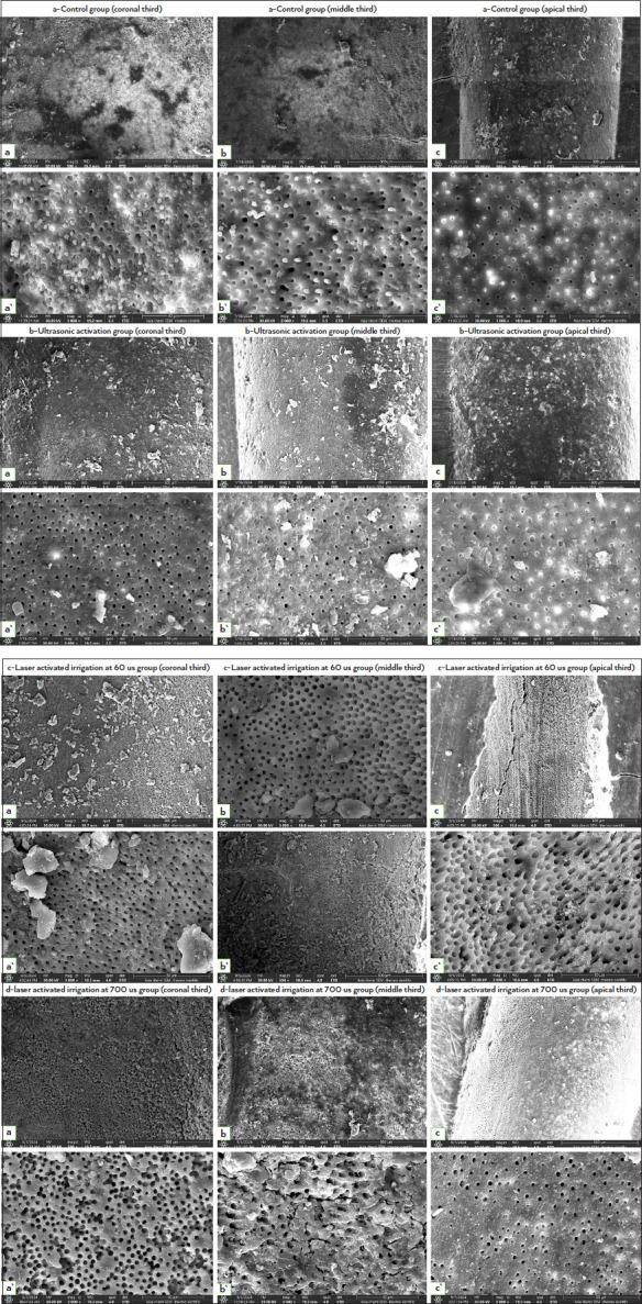 Investigating the Effect of PIPS Technique by Using Er,Cr: YSGG Irradiation for Sealer Removal in Endodontic Retreatment.