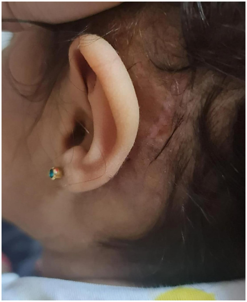 Cochlear implantation in children with Bartter syndrome: A case report.