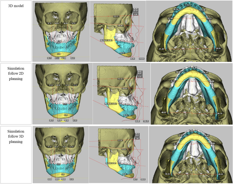 Comparison of accuracy of maxilla between virtual surgical planning and conventional surgical planning in bimaxillary orthognathic surgery: a randomized controlled trial.