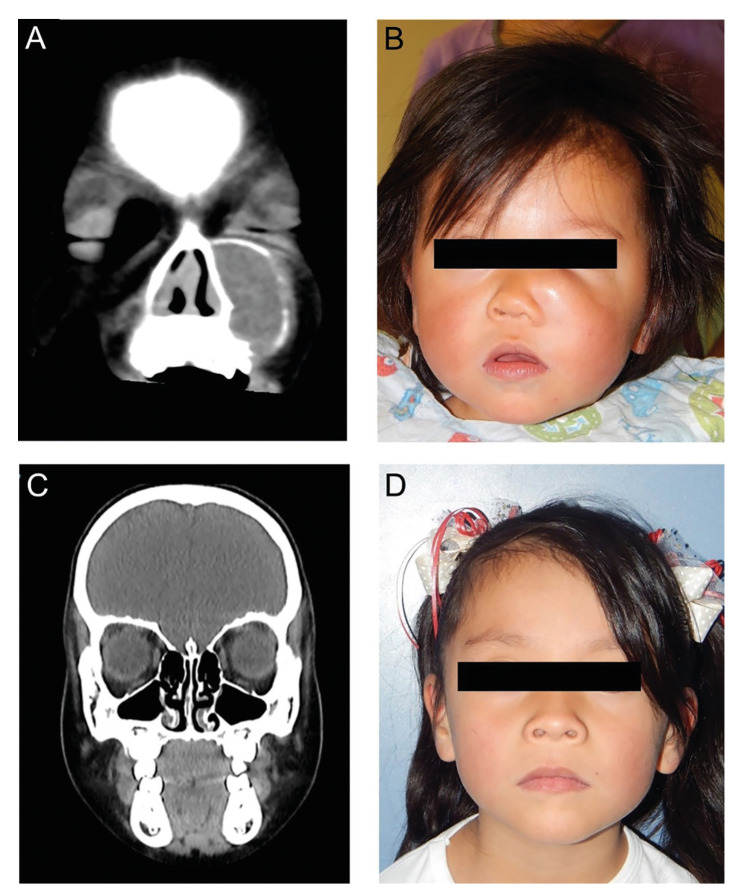 Myofibromas of the jawbones in pediatric patients. A clinicopathological study.