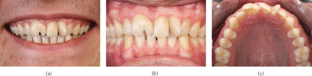 Esthetic Management in Geminated and Supernumerary Maxillary Incisor Teeth With a Conservative Interdisciplinary Approach.