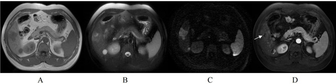 Prognostic Value of Gd-BOPTA Enhanced MRI in Solitary Resected Hepatocellular Carcinoma Without Microvascular Invasion.