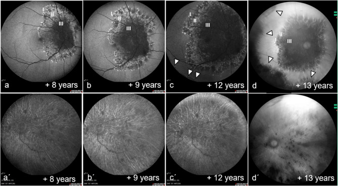 Multizonal outer retinopathy and retinal pigment epitheliopathy (MORR) with a chronologically divergent presentation- a case report.