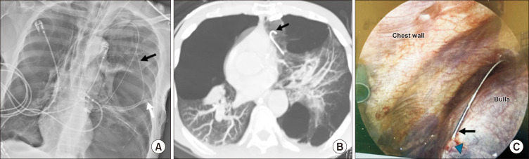 Missing Guidewire in a Bulla: A Case Report.