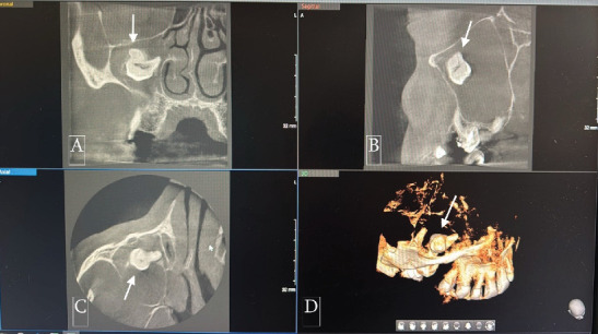 A Rare Case Report of a Large Dentigerous Cyst in the Maxillary Sinus Associated With an Ectopic Maxillary Third Molar.