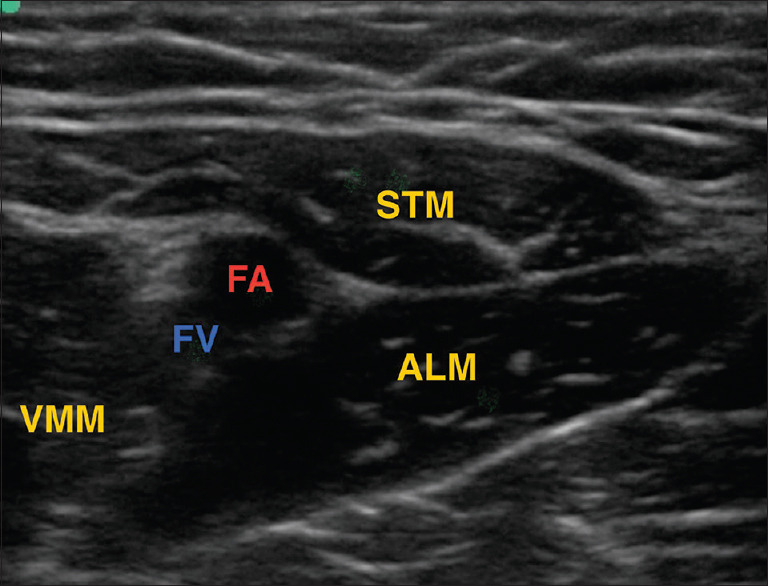Comparative analysis of dual versus single subsartorial block for postoperative analgesia after total knee arthroplasty - A randomized, double-blind study.