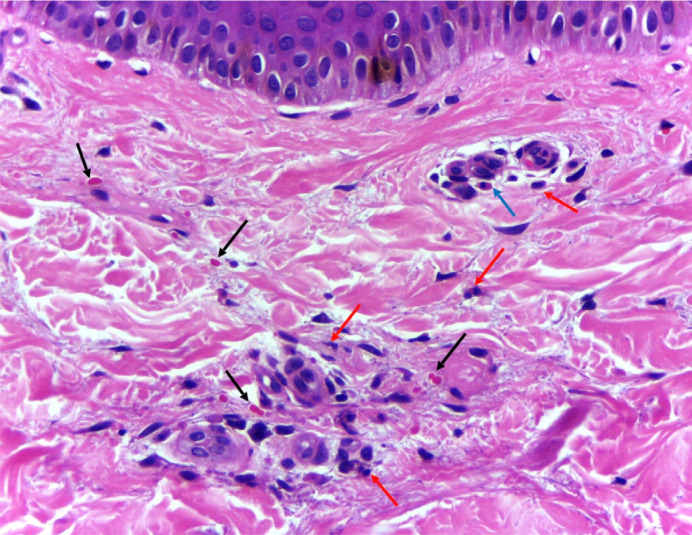 Multi systemic compromise due to Bartonella henselae in a child.