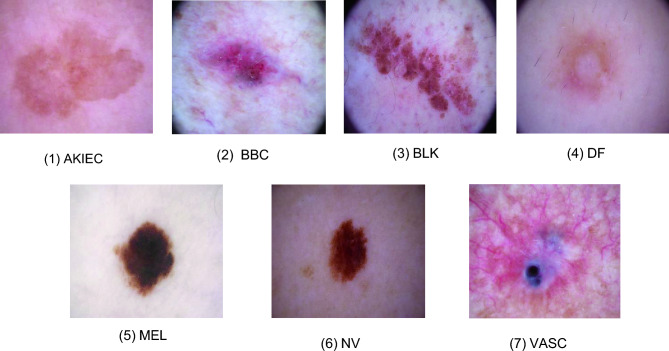 Stepwise self-knowledge distillation for skin lesion image classification.