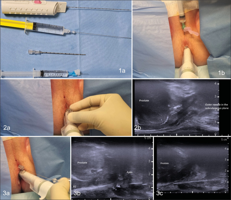Diagnostic precision, safety, and patient experience of the freehand transperineal prostate biopsy technique under local anesthesia - A single-center experience.
