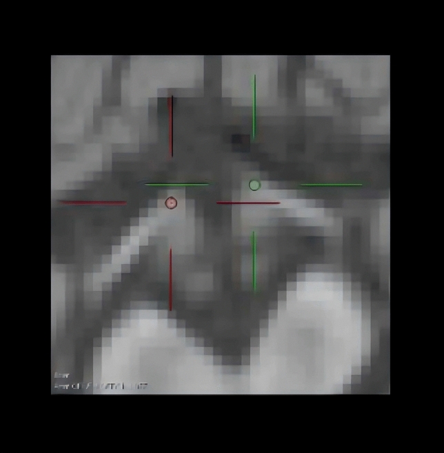 Microstructural injury to the optic nerve with vigabatrin treatment in West syndrome: A DTI study.