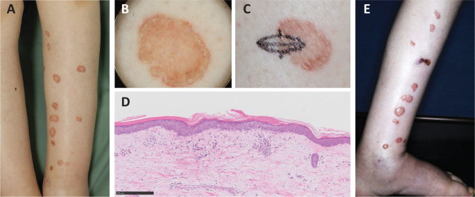 Tense Bullous Eruptions Arising in Porokeratosis: A Quiz.