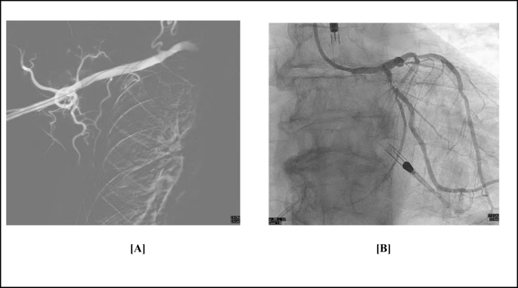 Navigating high-risk PCI with axillary impella support: a case report.