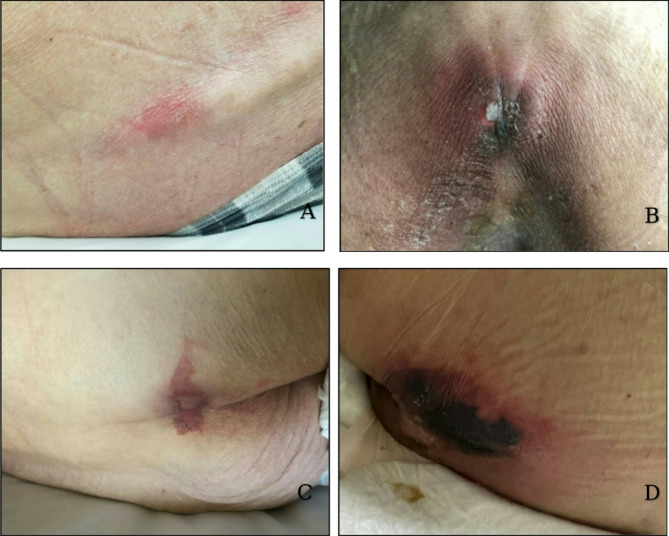 Testing the study protocol and interrater reliability of a new end-of-life wound assessment tool: a feasibility study.
