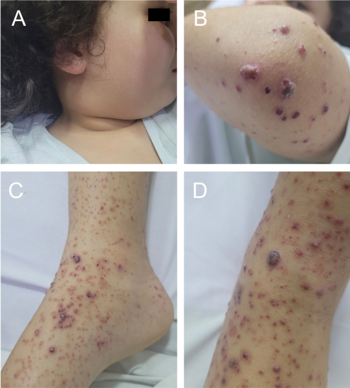 Multi systemic compromise due to Bartonella henselae in a child.