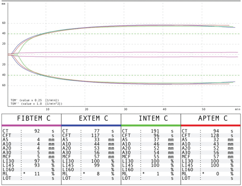 A novel pathogenic variant in the fibrinogen gamma chain gene p.Glu275Lys causes congenital hypofibrinogenemia.
