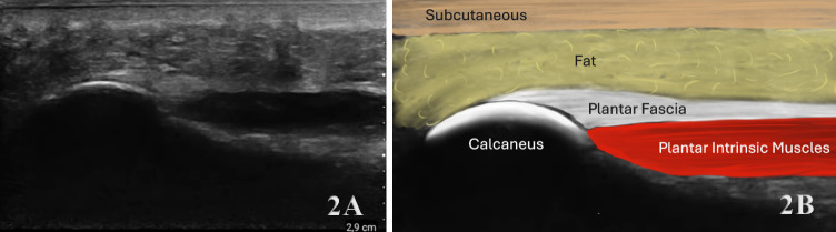 Diagnostic Musculoskeletal Ultrasound in the Evaluation of the Plantar Fascia.