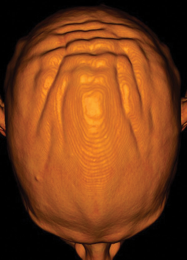 Cutis Verticis Gyrata: A Secondary Form of a Rare Skin Condition Caused by Growth Hormone Therapy.