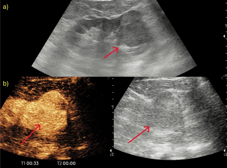 Contrast-enhanced ultrasound in the evaluation and management of solid renal lesions based on EFSUMB guidelines.