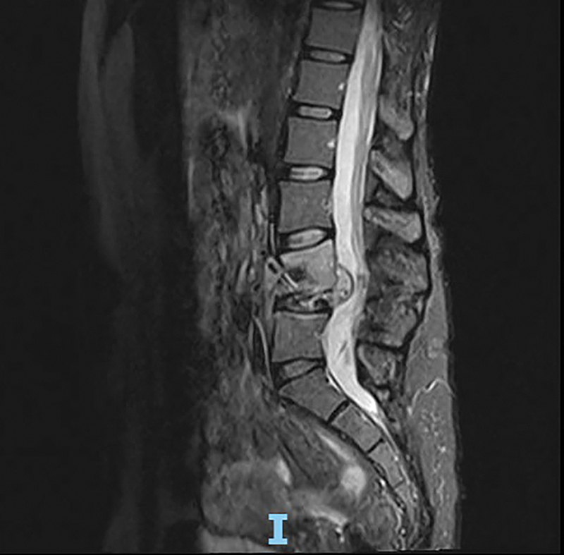 Active tuberculosis and multiple sclerosis: the importance of screening before treatment.