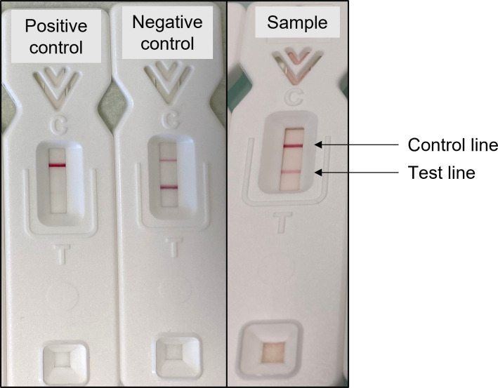Detection of <i>Mucorales</i> antigen in bronchoalveolar lavage samples using a newly developed lateral-flow device.