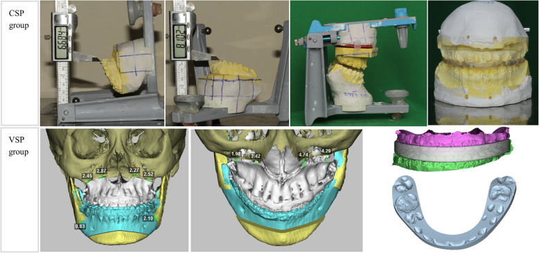 Comparison of accuracy of maxilla between virtual surgical planning and conventional surgical planning in bimaxillary orthognathic surgery: a randomized controlled trial.