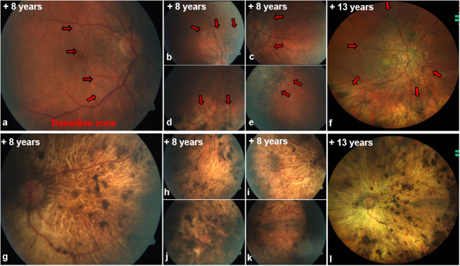 Multizonal outer retinopathy and retinal pigment epitheliopathy (MORR) with a chronologically divergent presentation- a case report.