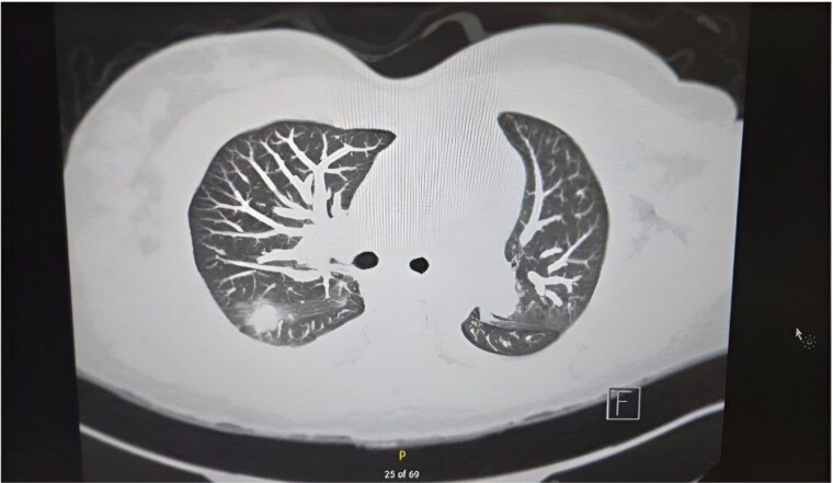 Catastrophic antiphospholipid syndrome in a young patient: a case report of severe multi-organ and cardiovascular involvement.