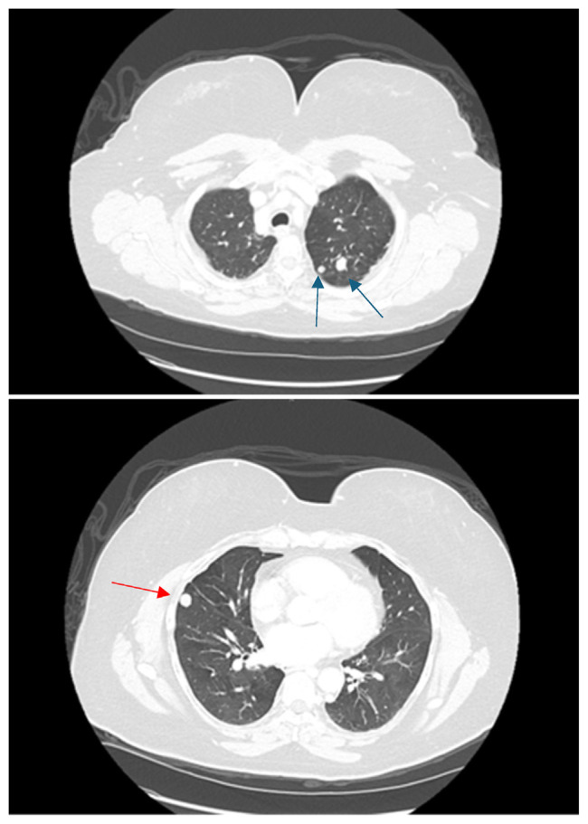 Late Onset Malignant Metastatic Transformation of Benign Pheochromocytoma.