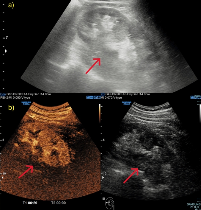 Contrast-enhanced ultrasound in the evaluation and management of solid renal lesions based on EFSUMB guidelines.