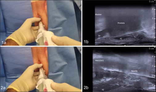 Diagnostic precision, safety, and patient experience of the freehand transperineal prostate biopsy technique under local anesthesia - A single-center experience.