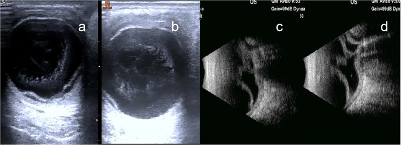 Retinal and choroidal detachment following corneal wasp sting: a case report and literature review.